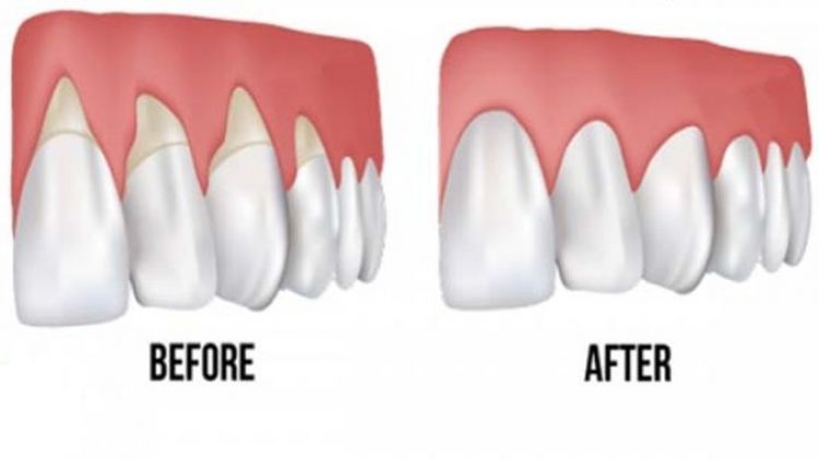 gum recession