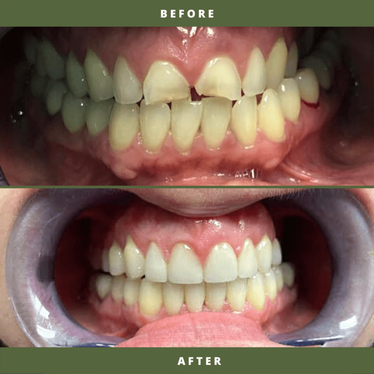 Our Before and After Gallery Live Oak Family Dental Care
