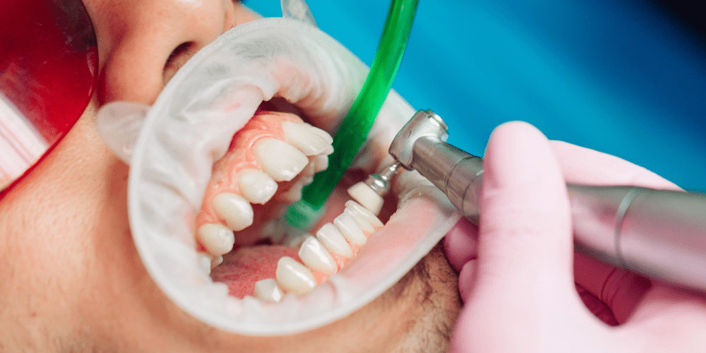 A person being worked on his tooth by a dentist