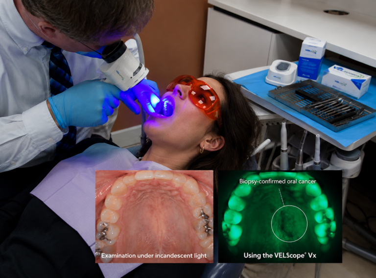 Dentist performing oral cancer screening using VELscope device with blue light during a dental exam to detect early abnormalities in oral tissue